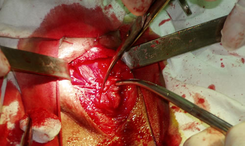 Выделение из рубцовых тканей проксимальной части уретры