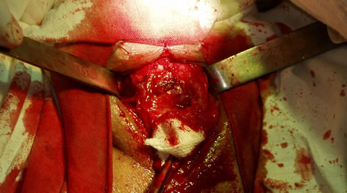 Виден "кратер" проксимальной уретры