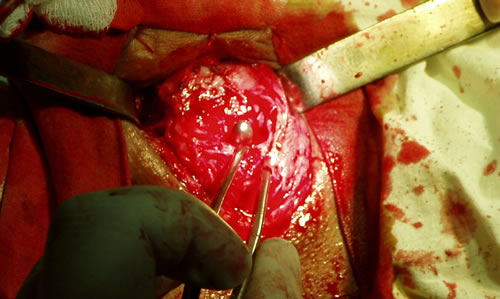 Виден буж, введенный в проксимальный отрезок уретры через надлобковый свищ