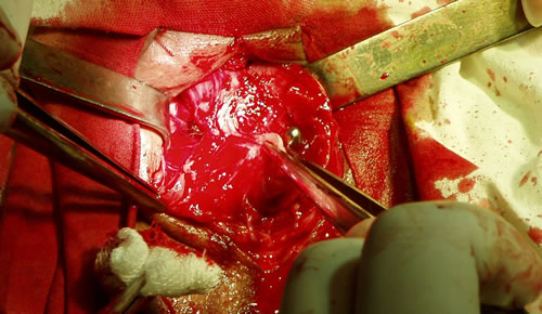 Удаление рубцовых тканей