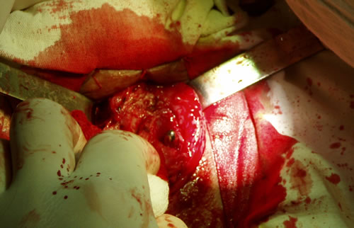 Виден буж и края бульбозного отдела уретры