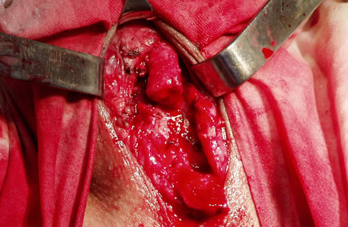 Концы уретры подготовлены к наложению анастомоза