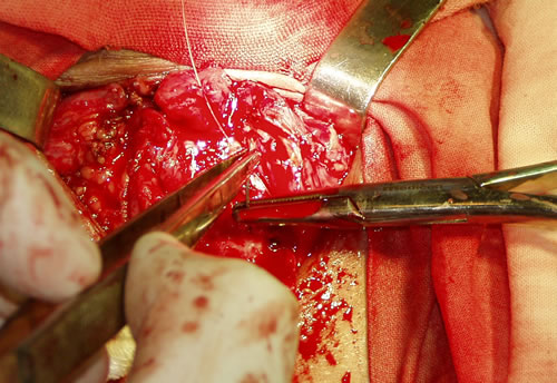 Наложение швов на проксимальный конец уретры (снаружи внутрь)