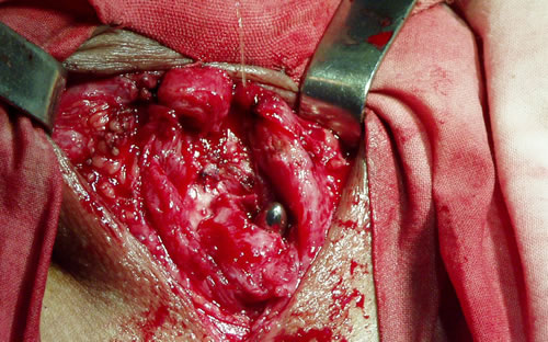 Наложение швов на проксимальный конец уретры (снаружи внутрь)