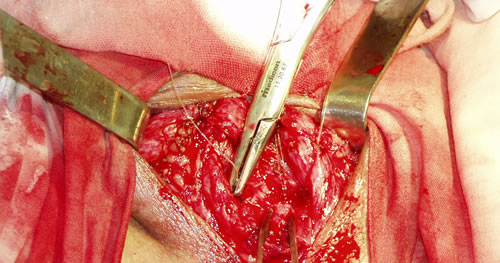 Наложение швов на проксимальный конец уретры (снаружи внутрь)э