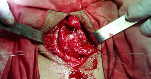 Швы наложены на проксимальный отрезок уретры (на 1, 4, 6, 8, 11, 12 часах) - всего 6 нитей