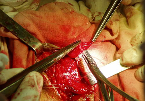 Наложение швов на дистальный конец уретры (изнутри наружу)