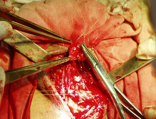 Наложение швов на дистальный конец уретры (изнутри наружу)