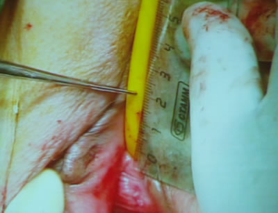 Профессор отмерил линейкой расстояние на котором он будет проводить вколы для проведения синтетической петли.