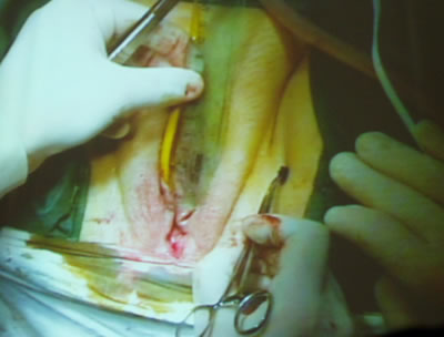 Отметил бриллиантовой зеленью места входа инструмента для трансобтураторного слинга.