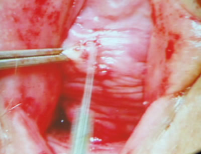 Отдельным разрезом на средине расстояния длинника уретры, оператор рассек отдельным разрезом слизистую влагалища и приступил ко второму этапу операции – трансобтураторному слингу