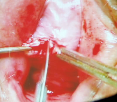 Отдельным разрезом на средине расстояния длинника уретры, оператор рассек отдельным разрезом слизистую влагалища и приступил ко второму этапу операции – трансобтураторному слингу