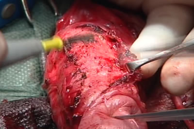 Аккуратно выделяется дорсальный сосудисто-нервный пучок