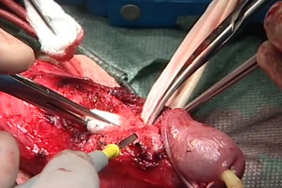 Дорсальный сосудисто-нервный пучок после его выделения взят на резиновую перчаточную держалку