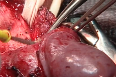 Дорсальный сосудисто-нервный пучок после его выделения взят на резиновую перчаточную держалку