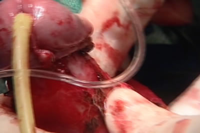 Оператор пальпаторно определяет бляшку