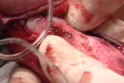 Оператор пальпаторно определяет бляшку