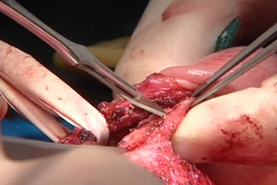 Бляшка рассекается скальпелем