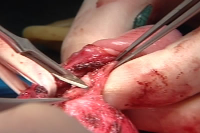 Бляшка рассекается скальпелем