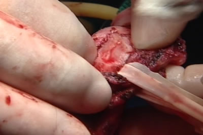 Бляшка рассекается скальпелем