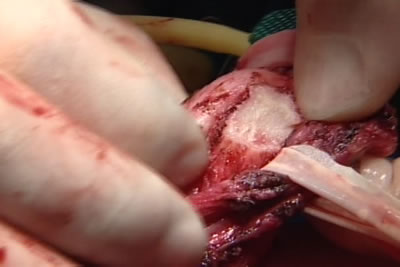 В результате сечения бляшки в кавернозном теле образуется дефект белочной оболочки