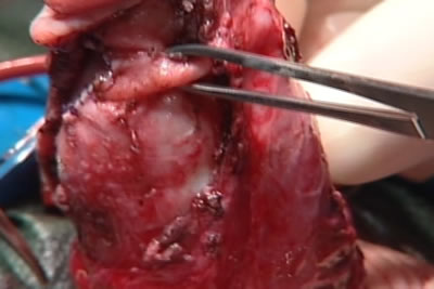 С целью его устранения оператор выполняет гофрирование белочной обочки кавернозного тела на противоположной искривленнию стороне