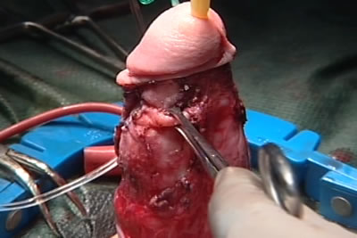 Для определения объема гофрирования оператор наложил инструмент на белочную оболочку. Половой член принял прямой вид