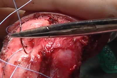 На белочную оболочку полового члена накладываются швы