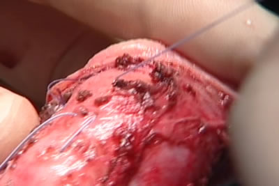 На белочную оболочку полового члена накладываются швы