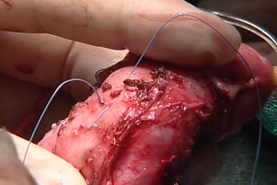 На белочную оболочку полового члена накладываются швы