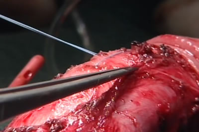 Швы затягиваются, выполняется гофрирование белочной оболочки