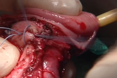 Швы затягиваются, выполняется гофрирование белочной оболочки