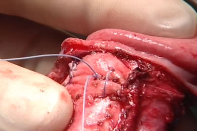 Швы затягиваются, выполняется гофрирование белочной оболочки