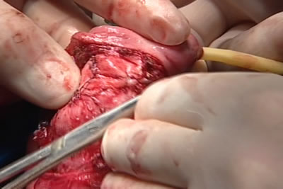 Швы наложена и завязаны