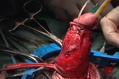 Моделирование эрекции и проверка результов операции