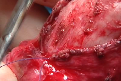 Ушивание фасции полового члена