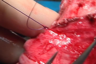 Ушивание фасции полового члена