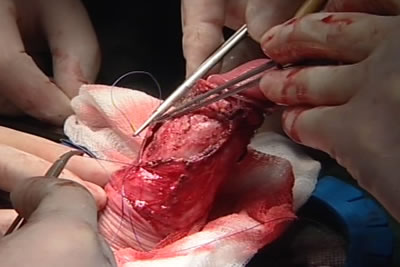 Ушивание фасции полового члена