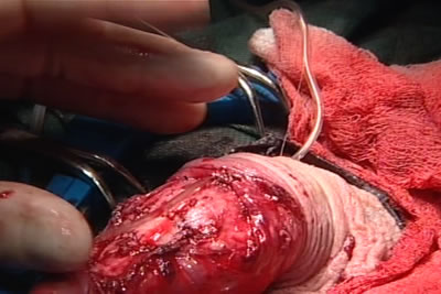 Через прокол у основания полового члена под кожу полового члена проводится трубчатый дренаж