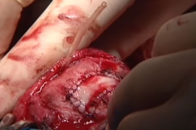 Через прокол у основания полового члена под кожу полового члена проводится трубчатый дренаж