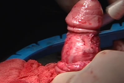 Кожа полового члена водворяется на прежнее свое место