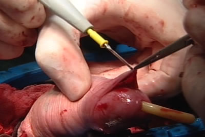 Этап циркумцизио (обрезание крайней плоти полового члена)