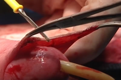 Этап циркумцизио (обрезание крайней плоти полового члена)