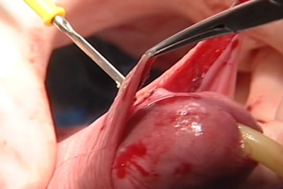 Этап циркумцизио (обрезание крайней плоти полового члена)