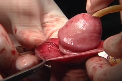 Этап циркумцизио (обрезание крайней плоти полового члена)