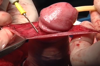 Этап циркумцизио (обрезание крайней плоти полового члена)