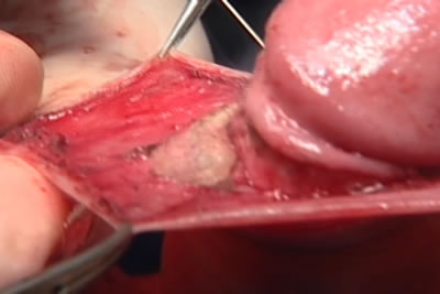 Этап циркумцизио (обрезание крайней плоти полового члена)