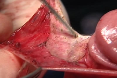 Этап циркумцизио (обрезание крайней плоти полового члена)