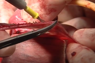 Этап циркумцизио (обрезание крайней плоти полового члена)