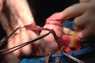 Крайняя плоть отсечена